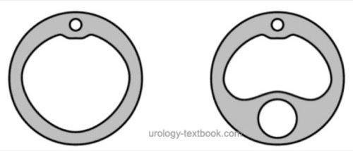 figure Cross-section of a Foley catheter (left) and irrigation catheter (right)