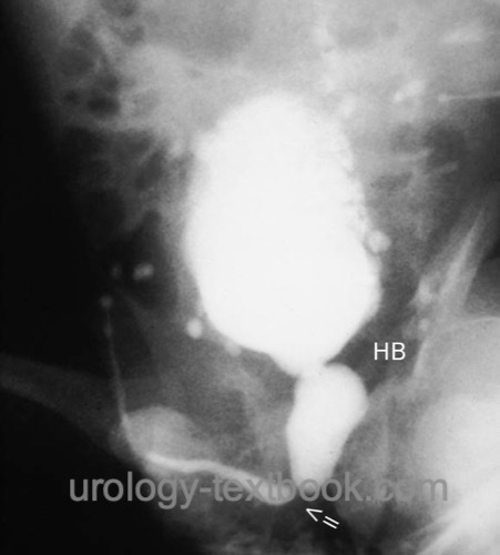 figure voiding cystourethrography in posterior urethral valve: multiple diverticula in a trabeculated bladder are signs of voiding with high pressures, the prostatic urethra is dilated between elevated bladder neck (HB) and urethral valve