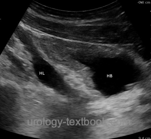 figure Sonography of the urinary bladder (HB) in sagittal section: marked bladder wall thickening and retrovesical megaureter (HL) in a 20-year-old patient with urethral valve treatment in childhood