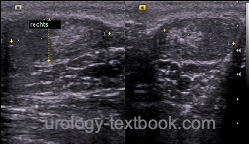 figure Testicular ultrasound imaging in a patient with Klinefelter syndrome 