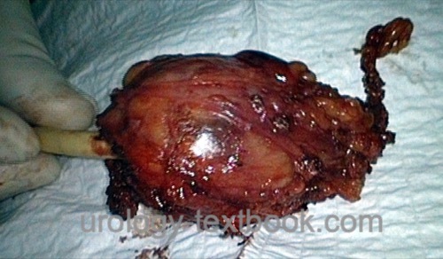 figure Postoperative specimen of a large bladder diverticulum