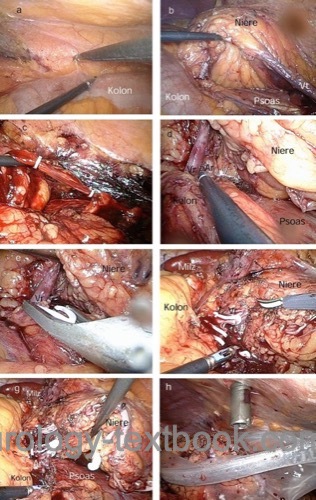 Figure laparoscopic radical nephrectomy surgical technique