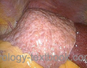 figure laparoscopy of hepatic cirrhosis