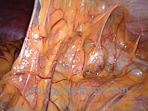 figure laparoscopy Peritoneal adhesions between the colon and the abdominal wall.