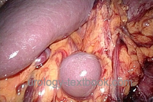 figure laparoscopy spleen and accessory spleen