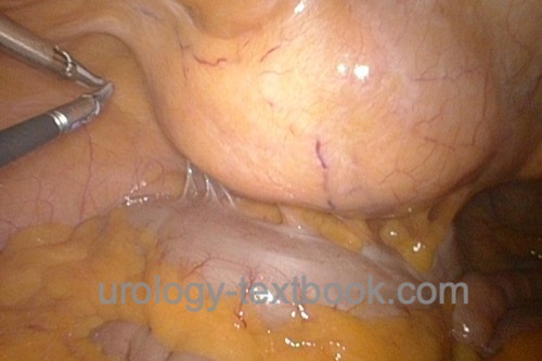 figure laparoscopy Left iliac fossa with a kidney graft.