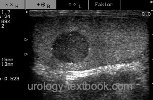 figure Leydig cell tumor in testicular ultrasound imaging: well-circumscribed hypoechoic testicular mass.