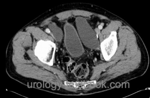 figure: Pelvic CT with lymphoceles after radical prostatectomy