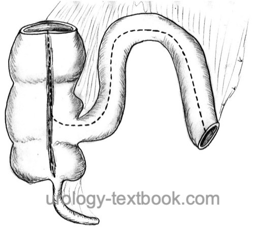 figure mainz pouch bowel dissection