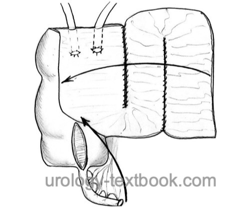 figure mainz pouch Detubularization and nonrefluxing ureterocolonic anastomosis