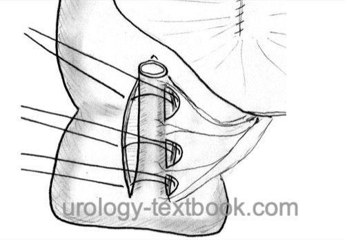 figure mainz pouch Continence mechanism with appendix.