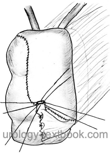 figure mainz pouch The pouch plate is folded in the longitudinal axis and closed with a running suture.