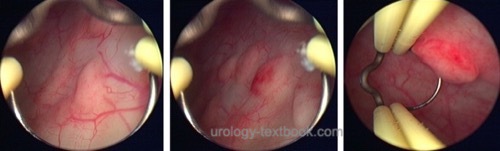 figure cystoscopy malacoplakia of the bladder