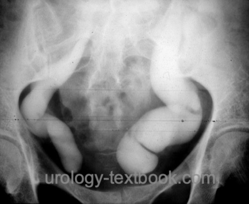 Abb. urography of primary obstructive megaureter