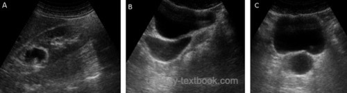 fig. retrograde pyelography of primary obstructive megaureter