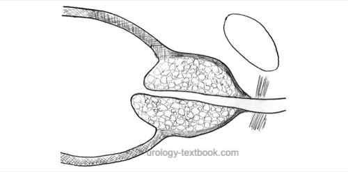 figure: surgical principle of retropubic simple prostatectomy for BPH