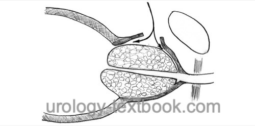 figure: surgical principle of retropubic simple prostatectomy for BPH