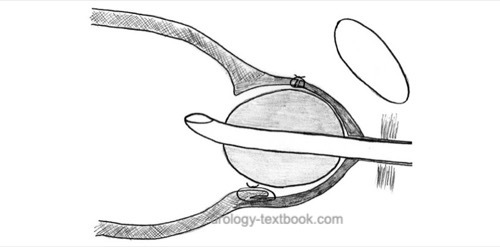 figure: surgical principle of retropubic simple prostatectomy for BPH